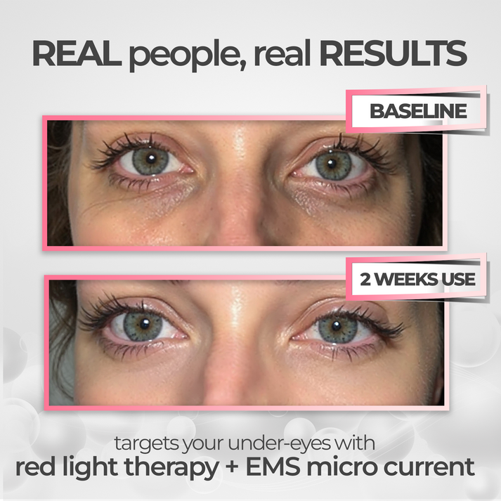 GlowEyes - Under-Eye Red Light Therapy