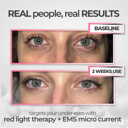 GlowEyes - Under-Eye Red Light Therapy